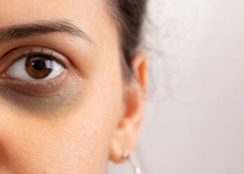 બટાટા દૂર કરશે ડાર્ક સર્કલની સમસ્યા, બસ આ રીતે ઉપયોગ કરો