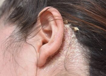 માથામાં પણ થાય છે ફંગલ ઇન્ફેક્શન, ટાલ થવાથી બચવા કરો આ ઉપાય